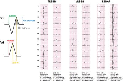 An Electrocardiographic Characterization of Left Bundle Branch Area Pacing-Induced Right Ventricular Activation Delay: A Comparison With Native Right Bundle Branch Block